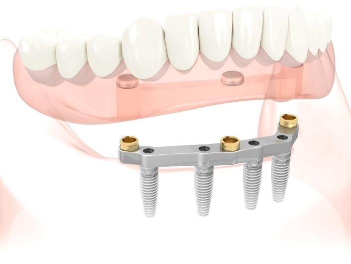 Densurefit For Lower Dentures Tampa FL 33609